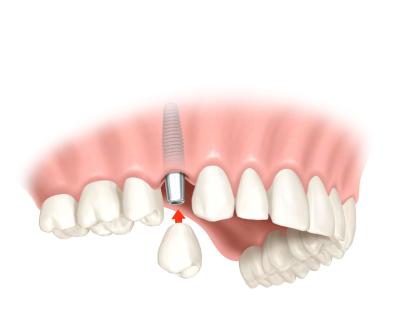 Computernavigierte Implantologie, Zahnimplantate Computernavigiert